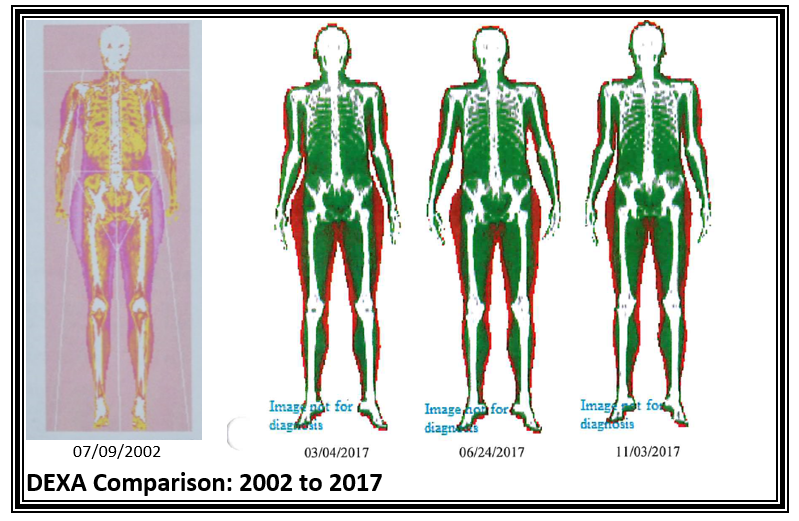 Changes in DEXA scan over time